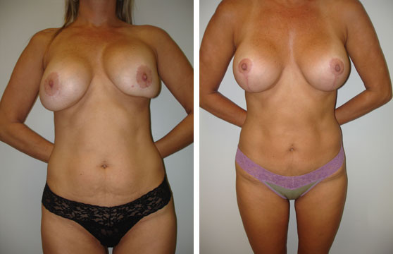 Грудь до и после оперирования капсулярной контрактуры