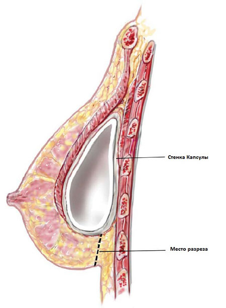 Разрез при капсулярной конрактуре