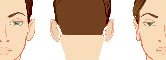 Повторная отопластика